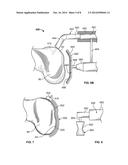 Patient-Specific-Bone-Cutting Guidance Instruments And Methods diagram and image