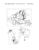 FOSSA OVALIS PENETRATION diagram and image