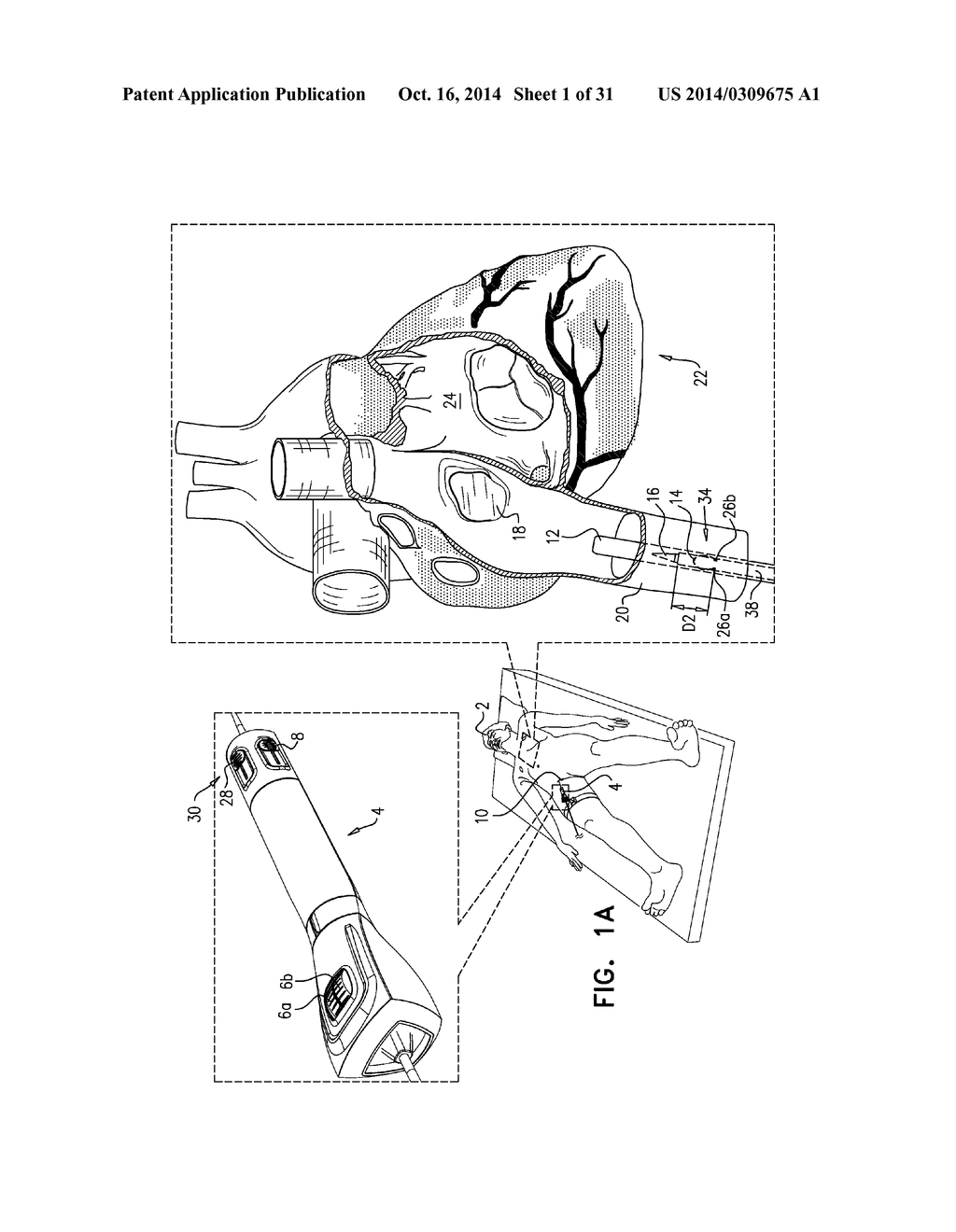 FOSSA OVALIS PENETRATION - diagram, schematic, and image 02