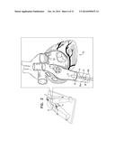 FOSSA OVALIS PENETRATION diagram and image