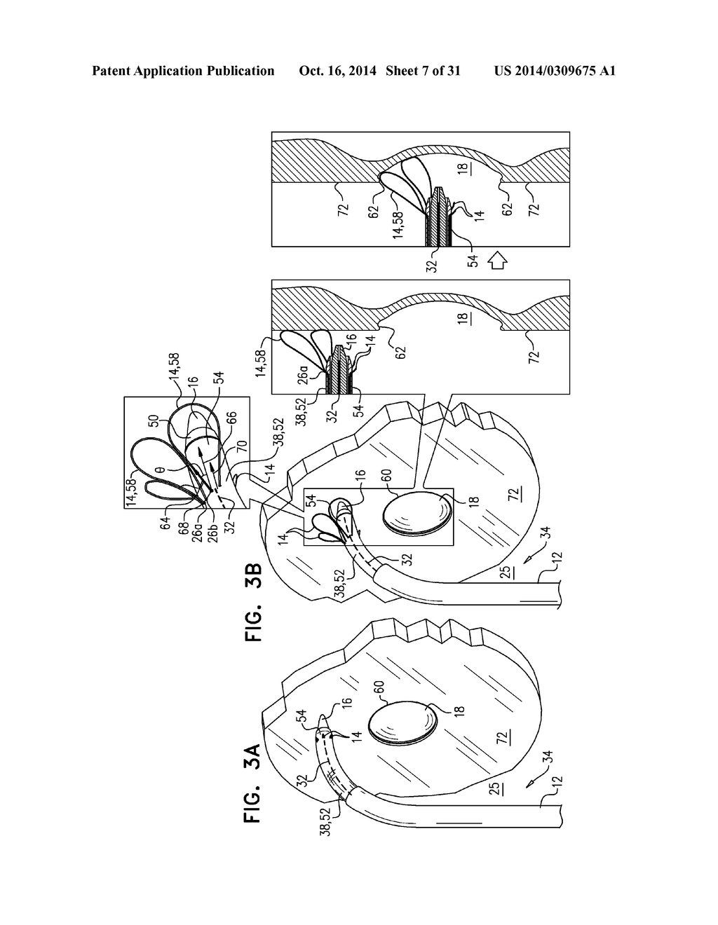 FOSSA OVALIS PENETRATION - diagram, schematic, and image 08