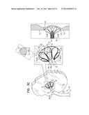 FOSSA OVALIS PENETRATION diagram and image