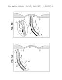 FOSSA OVALIS PENETRATION diagram and image