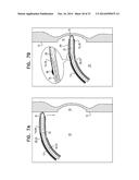 FOSSA OVALIS PENETRATION diagram and image