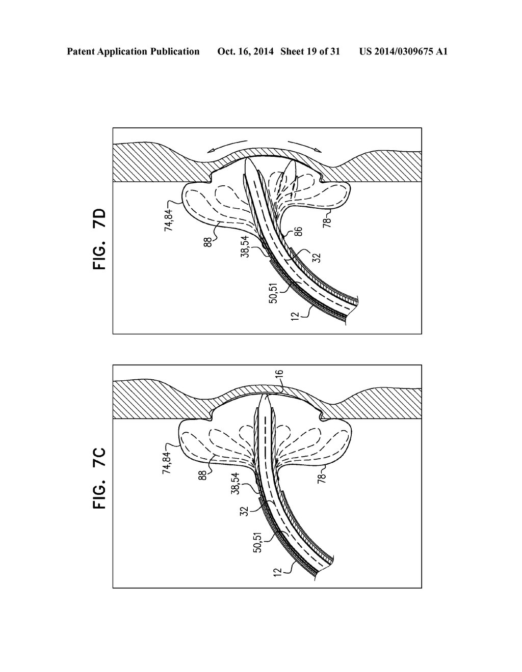 FOSSA OVALIS PENETRATION - diagram, schematic, and image 20