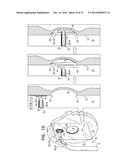 FOSSA OVALIS PENETRATION diagram and image