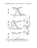 FOSSA OVALIS PENETRATION diagram and image