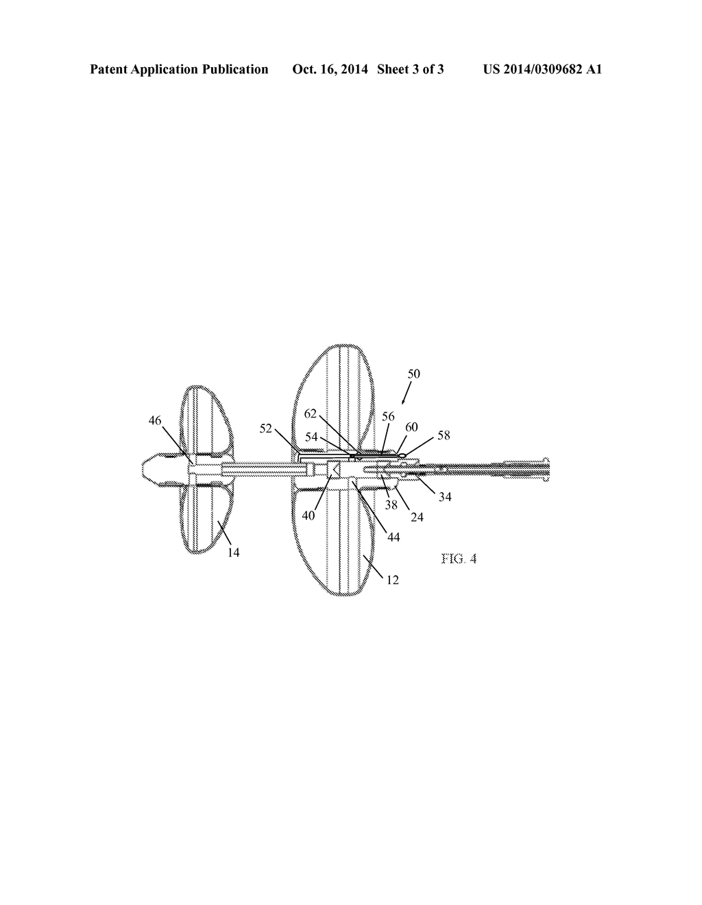 INFLATION AND DEFLATION OF OBSTRUCTION DEVICE - diagram, schematic, and image 04