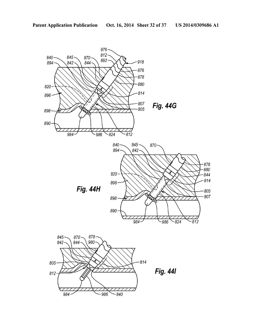 CLOSURE SYSTEM AND METHODS OF USE - diagram, schematic, and image 33