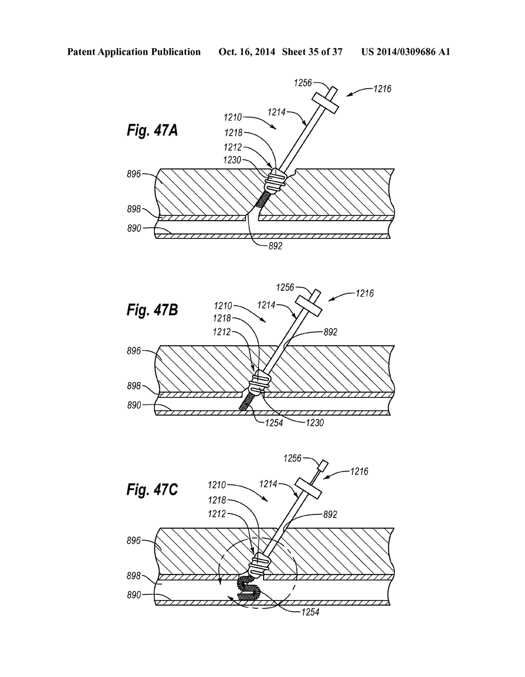 CLOSURE SYSTEM AND METHODS OF USE - diagram, schematic, and image 36