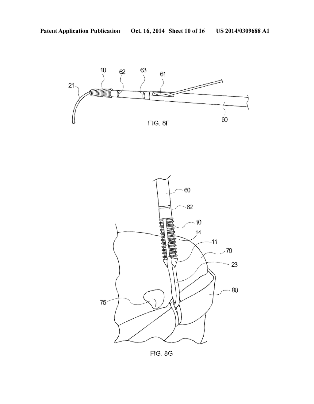KNOTLESS FILAMENT ANCHOR FOR SOFT TISSUE REPAIR - diagram, schematic, and image 11