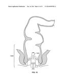 System and Method for Electrical Stimulation of Anorectal Structures to     Treat Anal Dysfunction diagram and image