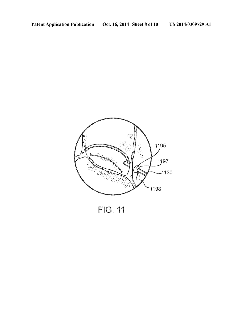 Devices and Methods for Treating Valvular Regurgitation - diagram, schematic, and image 09