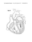 BLOOD FLOW CONTROLLING APPARATUS diagram and image