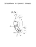 BLOOD FLOW CONTROLLING APPARATUS diagram and image