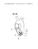 BLOOD FLOW CONTROLLING APPARATUS diagram and image