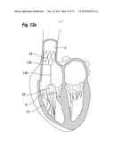 BLOOD FLOW CONTROLLING APPARATUS diagram and image