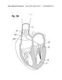 BLOOD FLOW CONTROLLING APPARATUS diagram and image