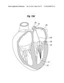 BLOOD FLOW CONTROLLING APPARATUS diagram and image