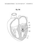 BLOOD FLOW CONTROLLING APPARATUS diagram and image