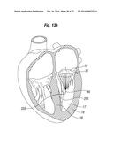 BLOOD FLOW CONTROLLING APPARATUS diagram and image