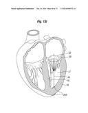 BLOOD FLOW CONTROLLING APPARATUS diagram and image