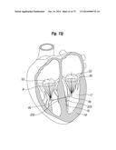 BLOOD FLOW CONTROLLING APPARATUS diagram and image