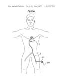 BLOOD FLOW CONTROLLING APPARATUS diagram and image