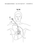 BLOOD FLOW CONTROLLING APPARATUS diagram and image