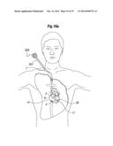 BLOOD FLOW CONTROLLING APPARATUS diagram and image