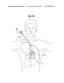 BLOOD FLOW CONTROLLING APPARATUS diagram and image