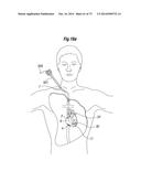 BLOOD FLOW CONTROLLING APPARATUS diagram and image