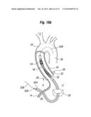 BLOOD FLOW CONTROLLING APPARATUS diagram and image