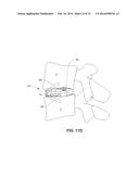 MODULAR, CUSTOMIZABLE SPINE STABILIZATION SYSTEM diagram and image