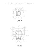 ASYMMETRICALLY RELEASABLE FASTENER SYSTEM AND CUFF FOR USE THEREWITH diagram and image