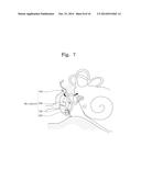 EASILY INSTALLABLE MICROPHONE FOR IMPLANTABLE HEARING AID diagram and image