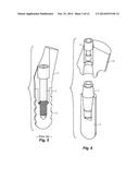 Laboratory Implant diagram and image