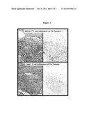 TREATING BLADDER CANCER PATIENTS AND IDENTIFYING BLADDER CANCER PATIENTS     RESPONSIVE TO TREATMENT diagram and image