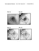 STIMULI RESPONSIVE ADHESIVE GEL FOR REMOVAL OF FOREIGN PARTICLES FROM SOFT     TISSUE diagram and image