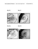 STIMULI RESPONSIVE ADHESIVE GEL FOR REMOVAL OF FOREIGN PARTICLES FROM SOFT     TISSUE diagram and image