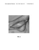 PREOPERATIVE IDENTIFICATION OF PERFORATOR VESSELS IN FLAPS TO BE USED IN     RECONSTRUCTIVE SURGERY diagram and image