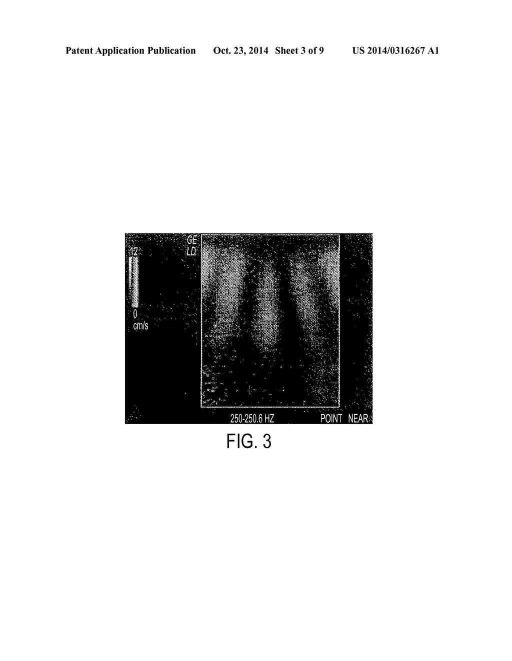 NON-INVASIVE ASSESSMENT OF LIVER FAT BY CRAWLING WAVE DISPERSION WITH     EMPHASIS ON ATTENUATION - diagram, schematic, and image 04