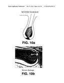 METHOD FOR ENHANCED PHOTOEPILATION BASED ON METALLIC NANO-COMPLEXES diagram and image