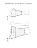 SYSTEMS AND METHODS FOR MINIMALLY INVASIVE FRACTURE REDUCTION AND FIXATION diagram and image