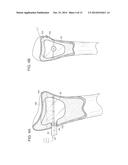 SYSTEMS AND METHODS FOR MINIMALLY INVASIVE FRACTURE REDUCTION AND FIXATION diagram and image