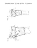 SYSTEMS AND METHODS FOR MINIMALLY INVASIVE FRACTURE REDUCTION AND FIXATION diagram and image