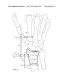 SYSTEMS AND METHODS FOR MINIMALLY INVASIVE FRACTURE REDUCTION AND FIXATION diagram and image