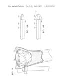 SYSTEMS AND METHODS FOR MINIMALLY INVASIVE FRACTURE REDUCTION AND FIXATION diagram and image