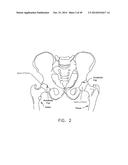 METHOD AND APPARATUS FOR RECONSTRUCTING A HIP JOINT, INCLUDING THE     PROVISION AND USE OF A NOVEL ARTHROSCOPIC DEBRIDEMENT TEMPLATE FOR     ASSISTING IN THE TREATMENT OF CAM-TYPE FEMOROACETABULAR IMPINGEMENT diagram and image