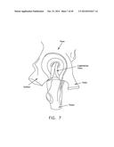 METHOD AND APPARATUS FOR RECONSTRUCTING A HIP JOINT, INCLUDING THE     PROVISION AND USE OF A NOVEL ARTHROSCOPIC DEBRIDEMENT TEMPLATE FOR     ASSISTING IN THE TREATMENT OF CAM-TYPE FEMOROACETABULAR IMPINGEMENT diagram and image